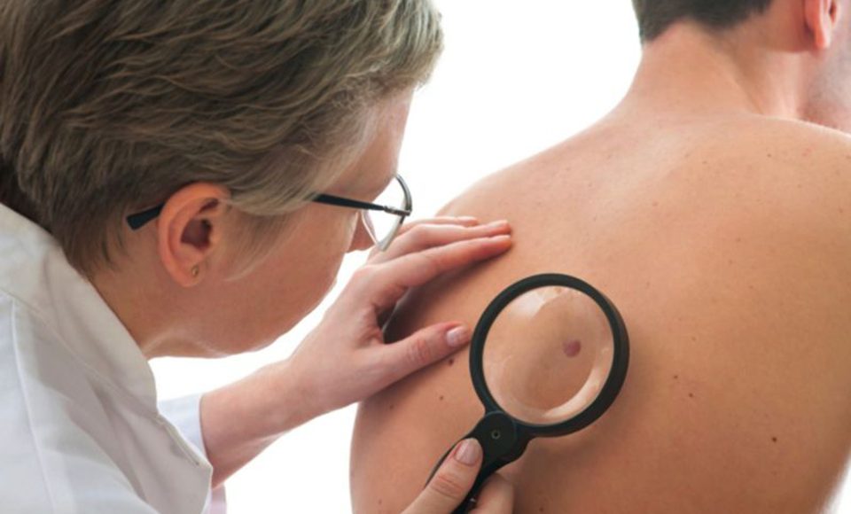 Prevenção câncer de pele.
Foto: Divulgação UEL
